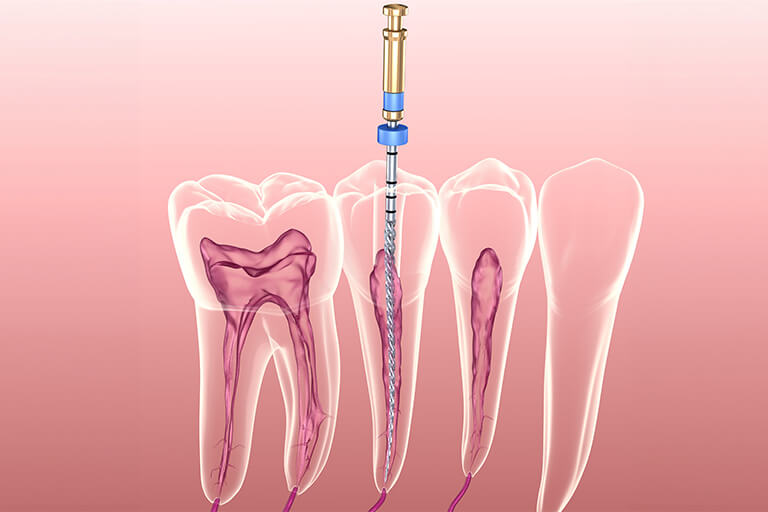 細菌によって汚染された根管内を清掃・消毒する「感染根管治療」