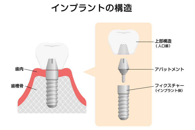 インプラントの構造と素材